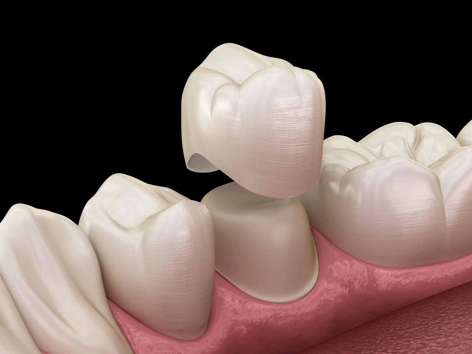 dental crowns in north haven CT
