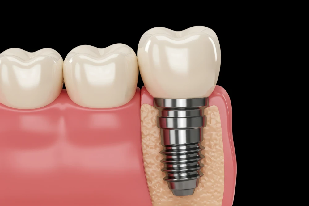 dental implants north haven ct